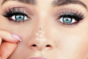 Method to hide peeling skin from chemical peel with makeup